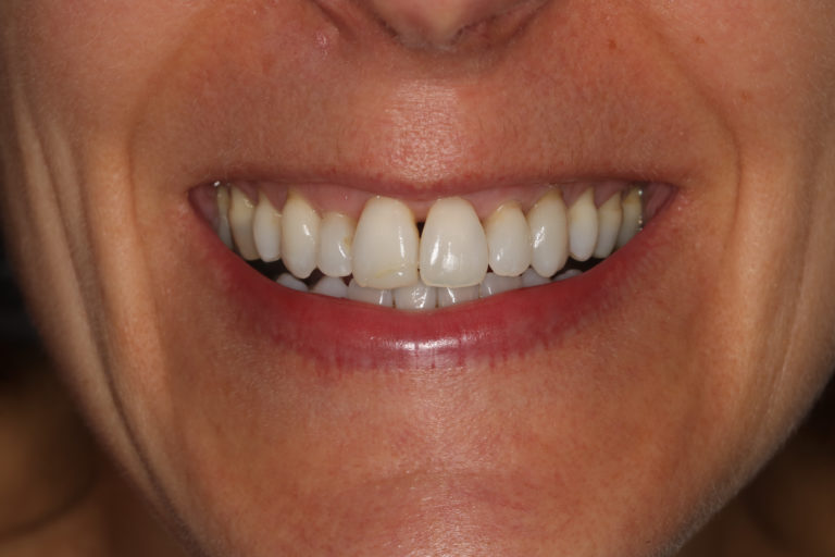 Black Triangles Between Teeth and Old Discoloured Fillings Esthetique Dental