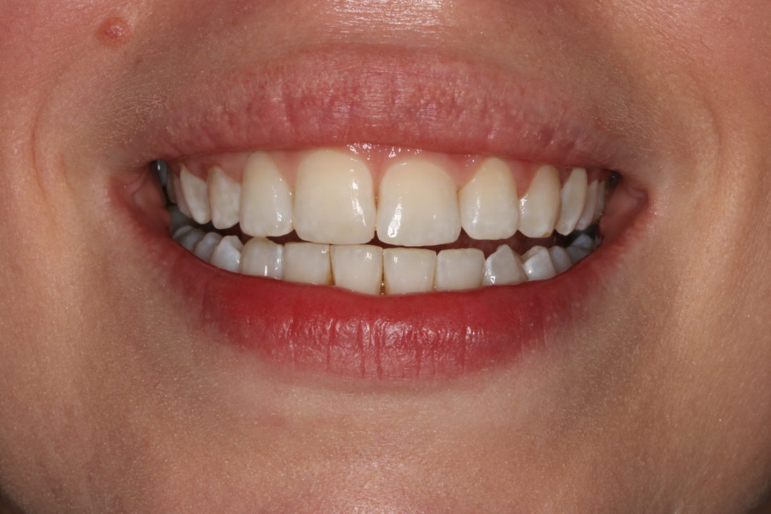 Cosmetic Orthodontic Treatment and Tooth Whitening Esthetique Dental