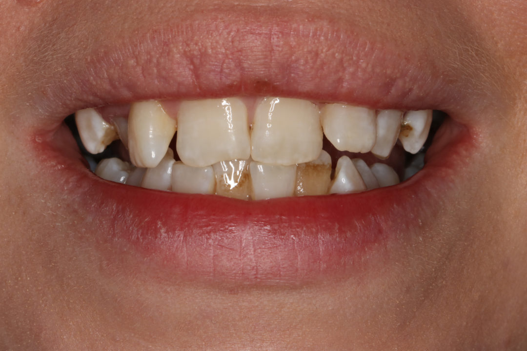 Cosmetic Orthodontic Treatment and Tooth Whitening Esthetique Dental