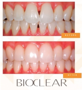 Bioclear Before and After