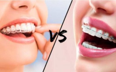 Aligners or Fixed Braces. Which Would Be Better?