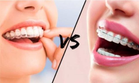 invisible aligners vs braces invisible aligners vs braces