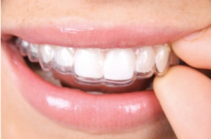 Aligners