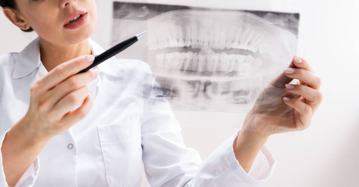 Everything You Need to Know About Wisdom Teeth