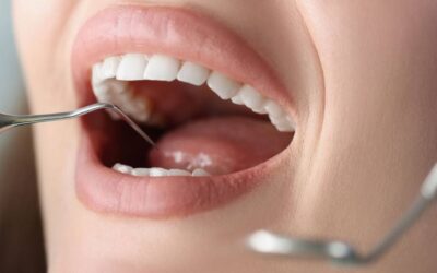 The Truth About Tooth Decay