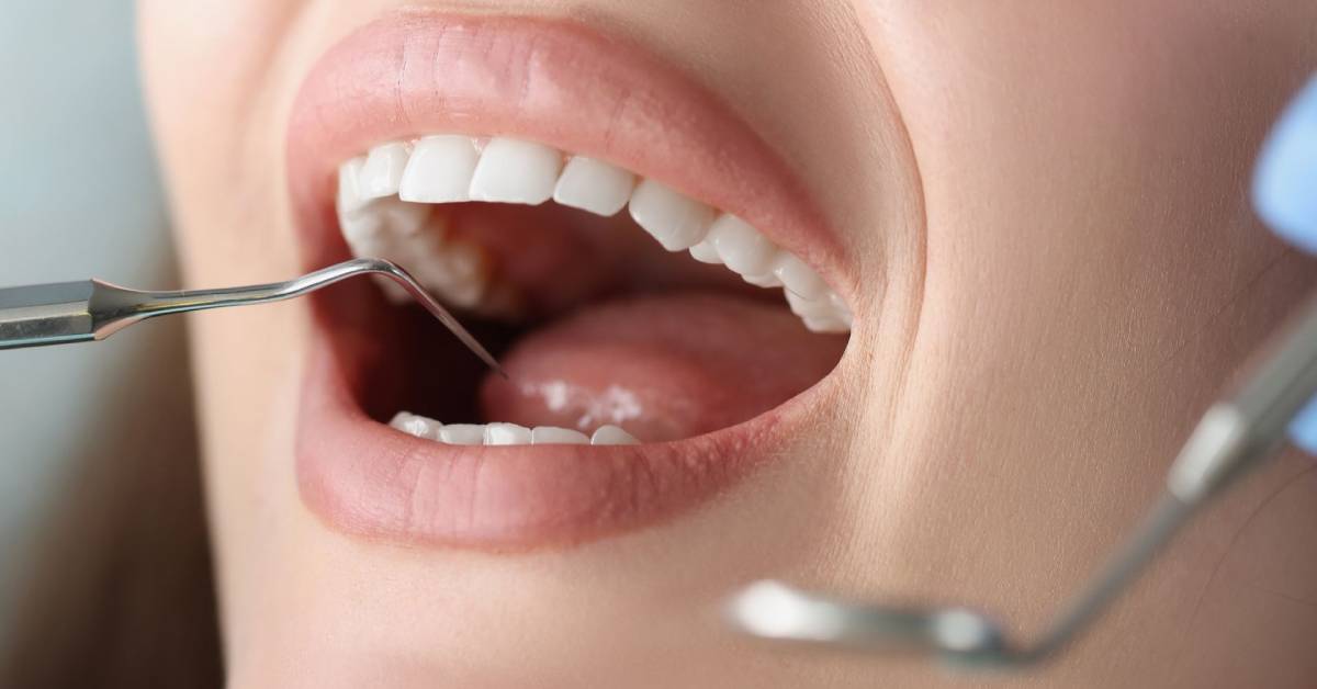 TruthAboutToothDecay_FB The Truth About Tooth Decay