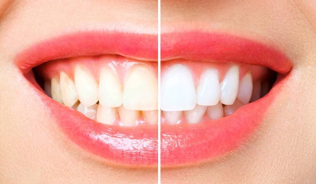 The Common Culprits Staining Your Teeth