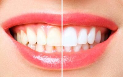 The Common Culprits Staining Your Teeth