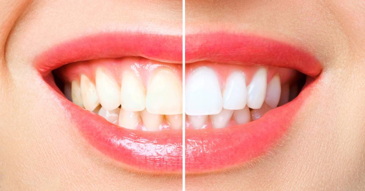 Teeth_Whitener The Common Culprits Staining Your Teeth, blog by Esthetique Dental