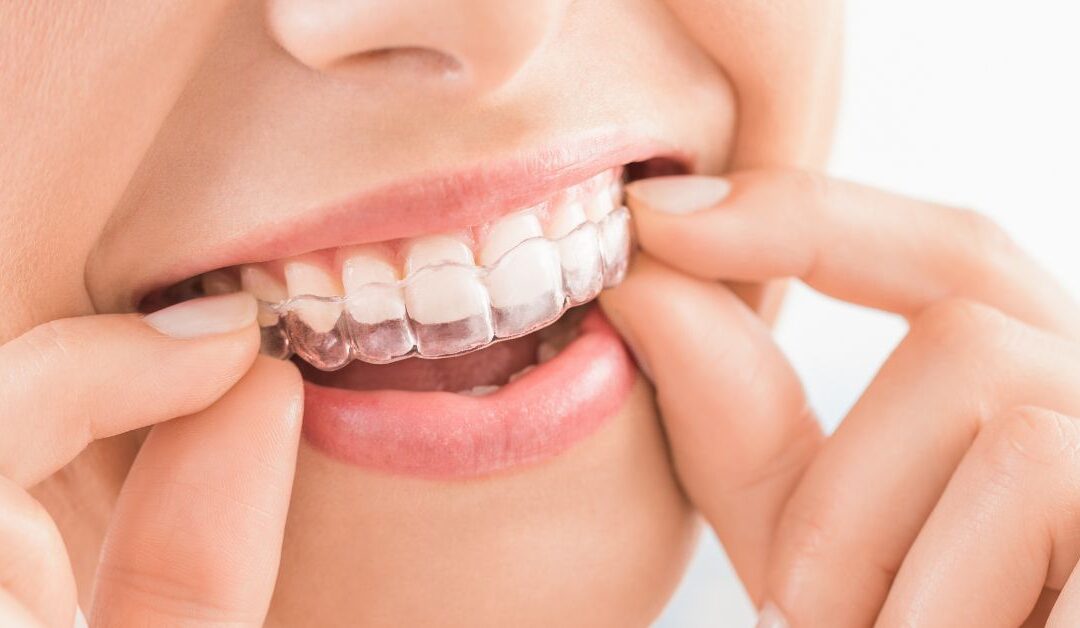 5 Common Invisalign Mistakes