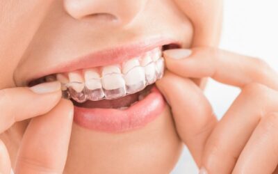 5 Common Invisalign Mistakes