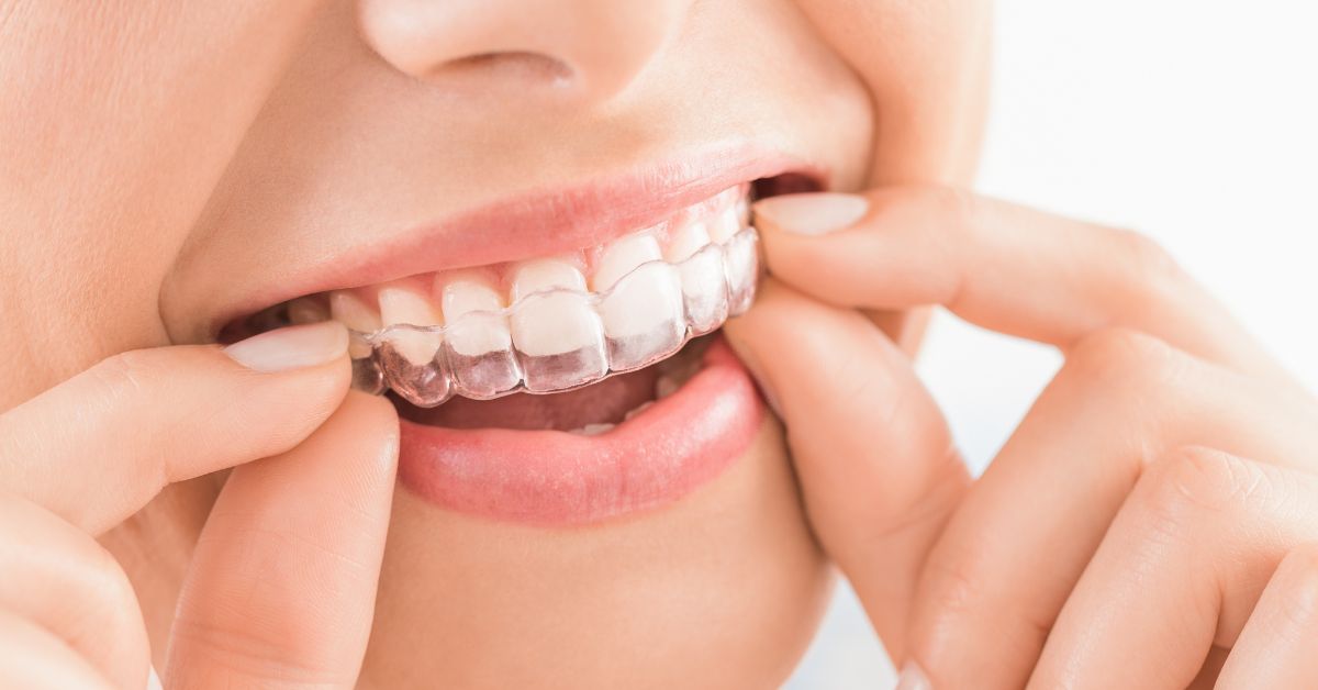 5 Common Invisalign Mistakes’ FB '5 Common Invisalign Mistakes’ blog by Esthetique Dental